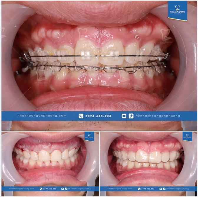 Thêm một chút nhấn nhá cho ca niềng răng của bạn Hoàng Quân thêm hoàn hảo