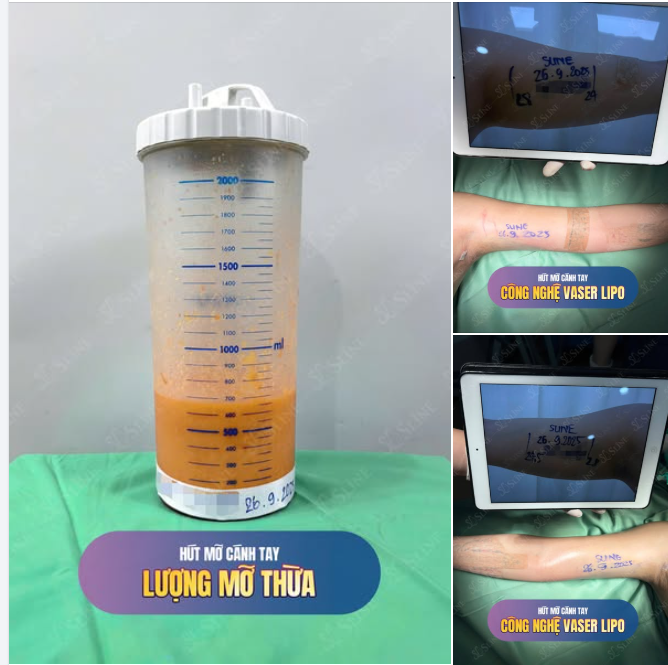 HÚT MỠ CÁNH TAY  " TẠM BIỆT MỠ THỪA, TỰ TIN KHOE DÁNG "