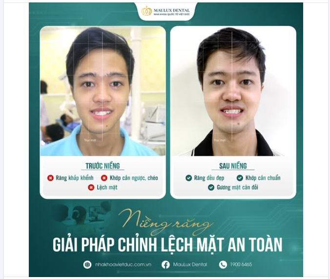HẾT LỆCH MẶT CHỈ NHỜ NIỀNG RĂNG