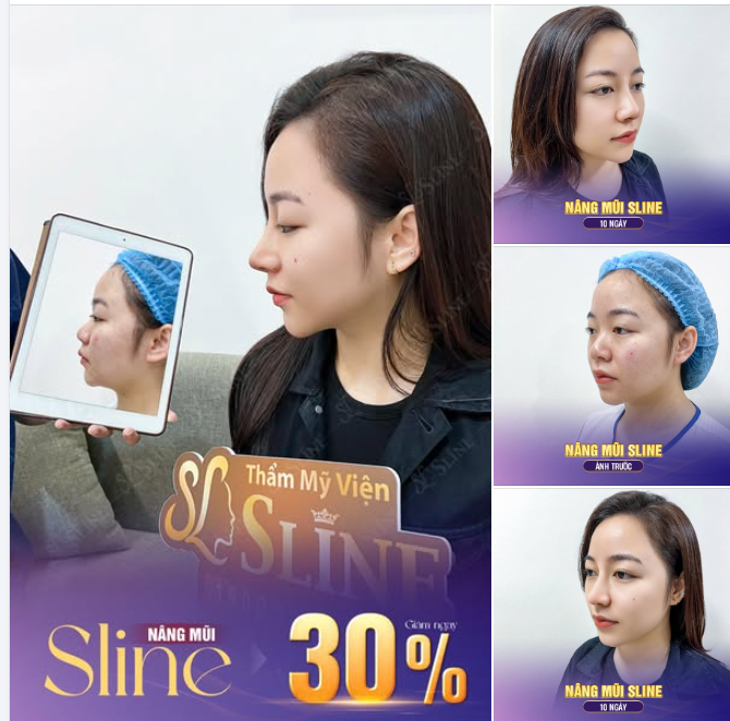 NÂNG MŨI SLINE – TỎA SÁNG DIỆN MẠO MỚI