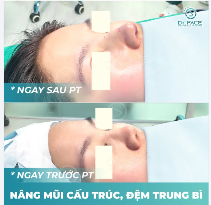 Bay 13.000 Km Từ Mỹ Về VN Chỉ Để Tự Tin Cười Trước Gương