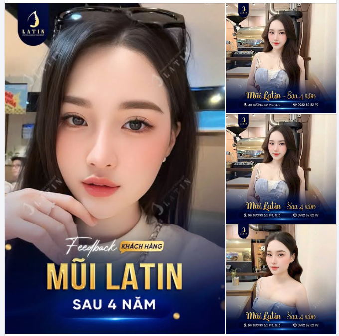 4 NĂM SAU NÂNG MŨI – VẪN ĐẸP CHUẨN “LATIN SIGNATURE”