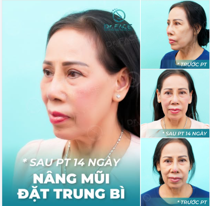 MŨI ĐỎ VIÊM NHƯ NÀY PHẢI LÀM SAO