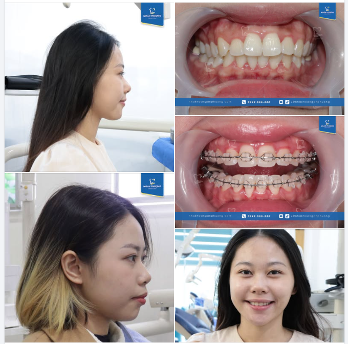 Hơn cả niềng răng, đó là hành trình tìm thấy phiên bản tốt hơn của chính mình