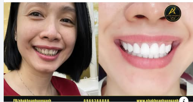 Smile Design – Nụ cười hoàn hảo với giải pháp công nghệ mới