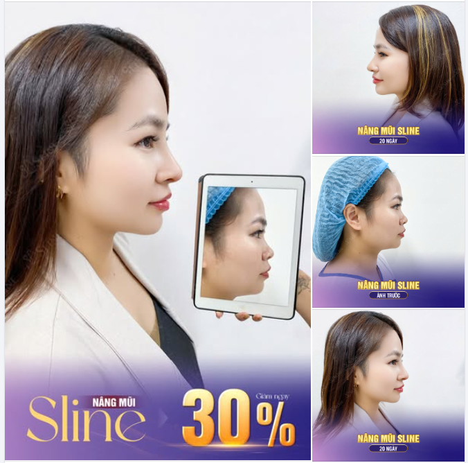 NÂNG MŨI SLINE – NHẸ NHÀNG, THANH TÚ