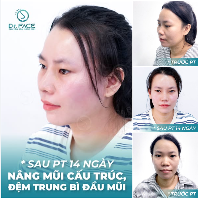 Mũi cao nghiêng nhẹ trời nghiêng  Xinh thêm một chút, tình duyên thêm nhiều