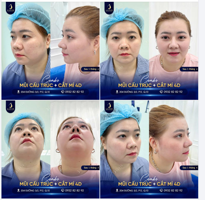 Làm 1 lần – Đẹp 1 lần  Chị khách sau 1 tháng thực hiện combo Nâng mũi + Cắt mí 4D tại Latin: