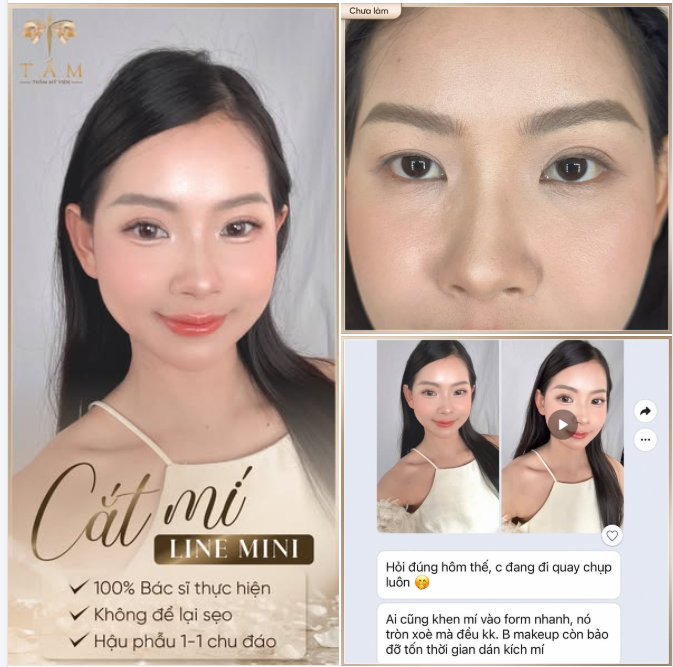 Cắt mí đã giúp Cẩm Tiên thay đổi thế nào?