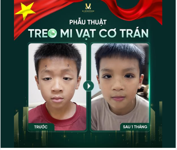 PHẪU THUẬT SỤP MÍ BẰNG PHƯƠNG PHÁP VẠT CƠ TRÁN NỘI SOI