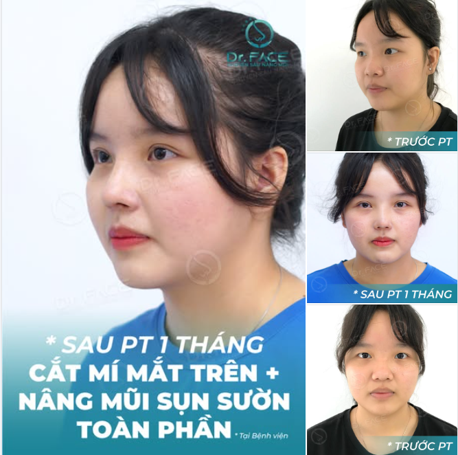 COMBO MŨI + MẮT: Bí quyết mẹ trao để con gái tự tin hơn