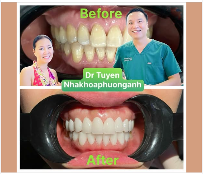 Bọc răng sứ giữ được bao lâu và hướng dẫn chăm sóc sau bọc răng