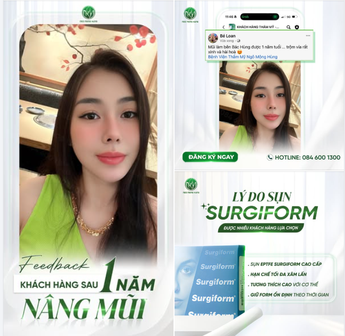 Nhan sắc quá đỗi ngọt ngào của chị khách sau 1 năm Nâng mũi