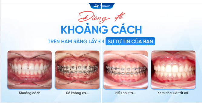 KHÉP LẠI KHOẢNG TRỐNG - MỞ RA NỤ CƯỜI NHỜ NIỀNG RĂNG X-MATRIX