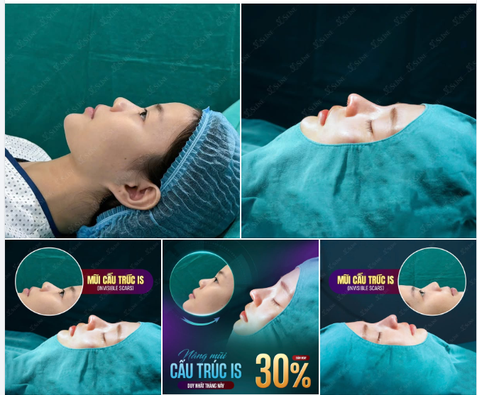 MŨI ĐẸP TỰ NHIÊN – TỰ TIN TỎA SÁNG