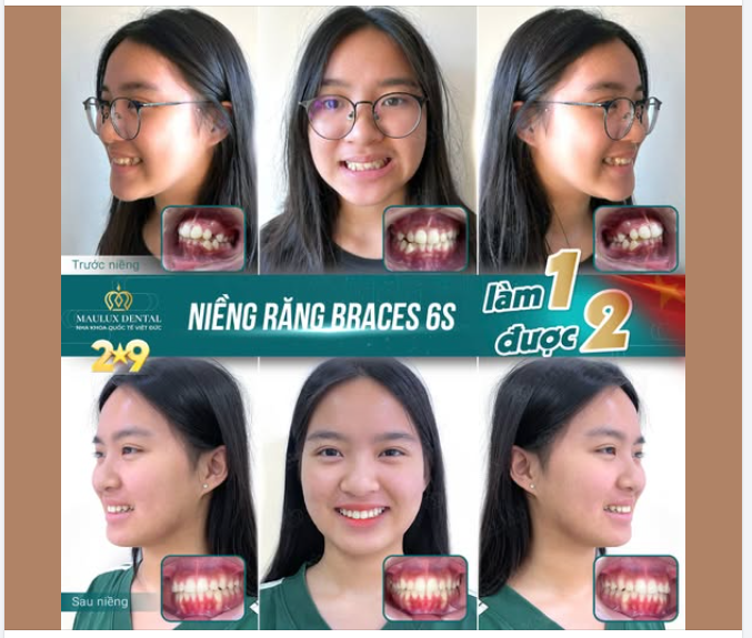 TỪ "BÉ RĂNG KHẤP KHỂNH" THÀNH "CÔ NÀNG NỤ CƯỜI TỎA SÁNG"