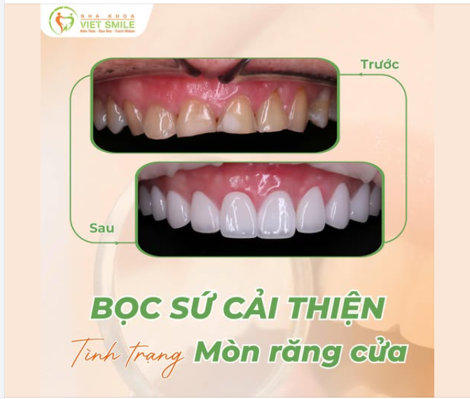 THẨM MỸ RĂNG SỨ – KHẮC PHỤC RĂNG XỈN MÀU, MÒN MẶT NHAI