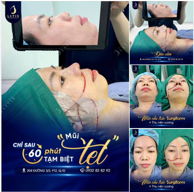 Chỉ 60 phút – Tạm biệt mũi thấp tẹt