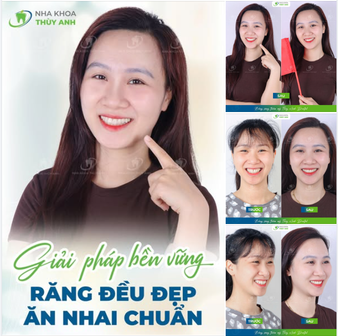 HÌNH DÁNG CỦA MỘT NỤ CƯỜI KHỎE ĐẸP TRỌN VẸN VỚI RĂNG THẬT