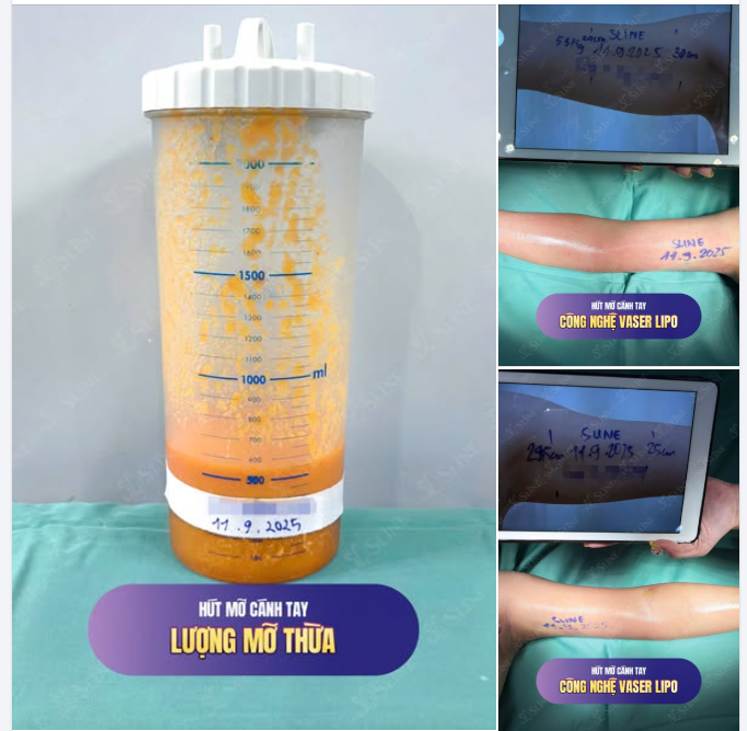 CASE THỰC TẾ – HÚT MỠ CÁNH TAY