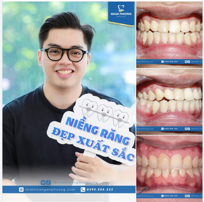 Đừng niềng răng khi quyết tâm chưa đủ lớn