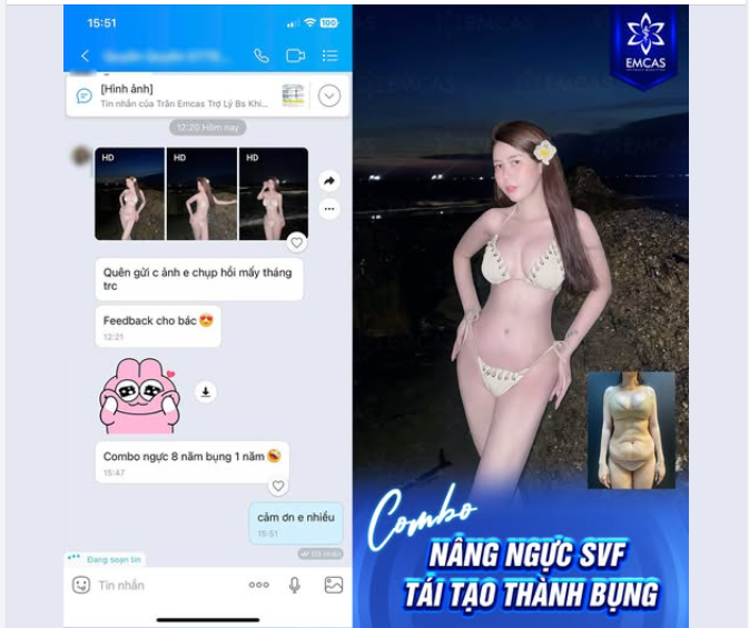 Combo Nâng ngực SVF 8 năm - Tái tạo thành bụng 1 năm