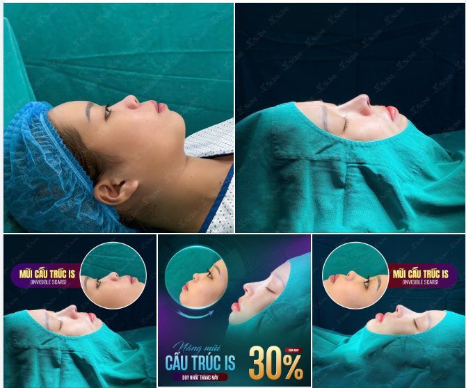 NÂNG MŨI CẤU TRÚC IS THĂNG HẠNG NHAN SẮC AN TOÀN.
