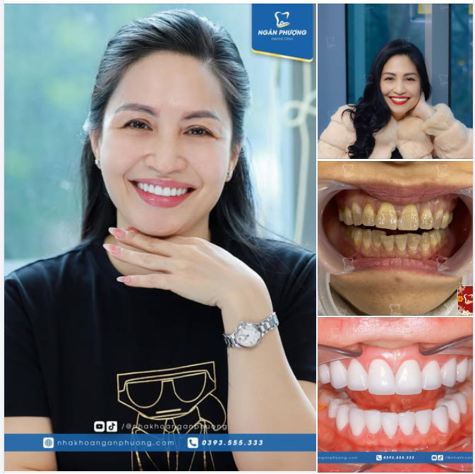 4 năm khắc phục răng nhiễm tetracyline, chị Huyền chỉ feedback "trên cả hài lòng"