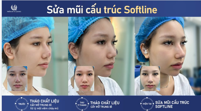 3 LẦN MŨI HỎNG VÀ CÁI KẾT SỬA MŨI LẦN 4…..