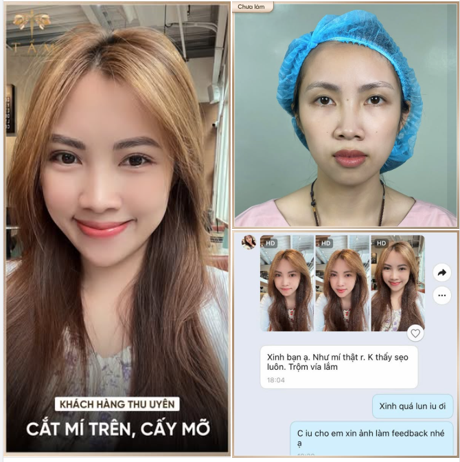 Cắt Mí Trên kết hợp Cấy Mỡ giúp khách hàng trẻ đến chục tuổi. Ảnh feedback cười rạng rỡ thế này là biết chị ưng nếp mí mới thế nào rồi đó