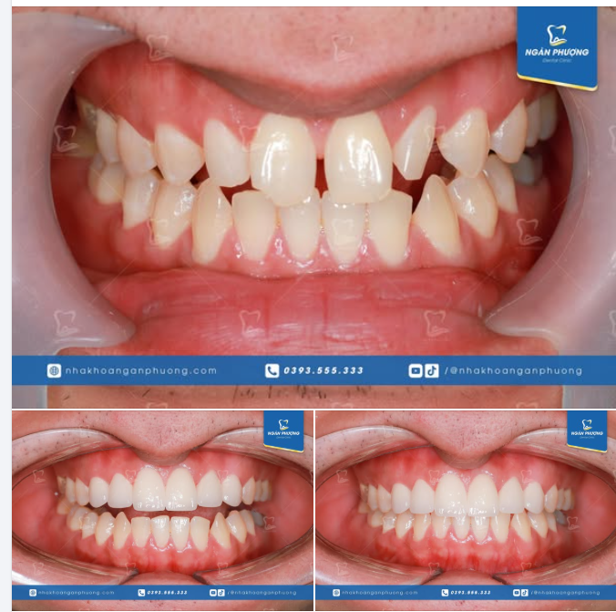 Răng thưa không niềng mà chọn làm sứ, là vì sao?