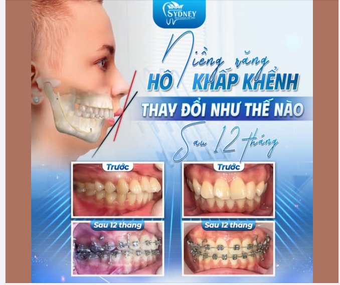 NIỀNG RĂNG HÔ, KHẤP KHỂNH THAY ĐỔI NHƯ THẾ NÀO SAU 12 THÁNG