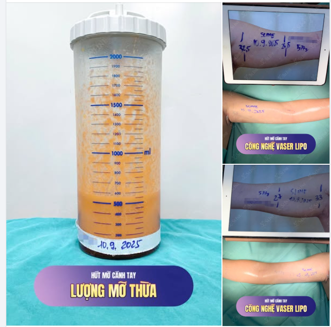HÚT MỠ CÁNH TAY – LẤY LẠI VẺ THON GỌN