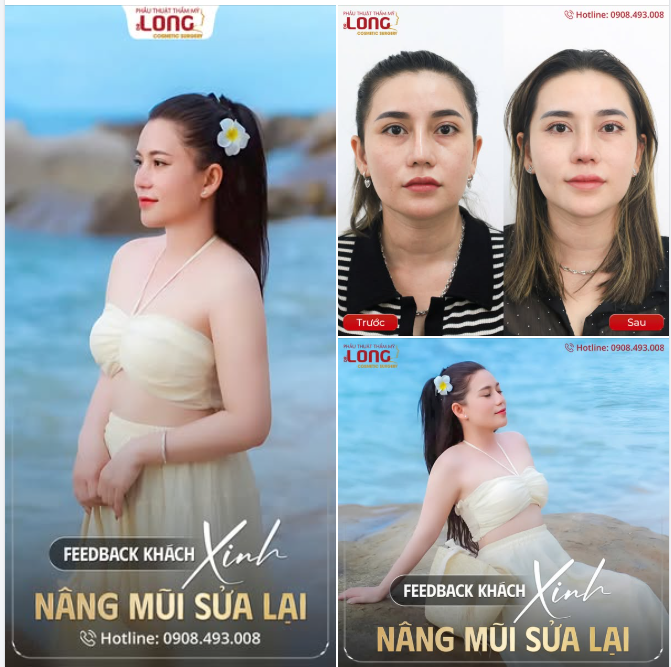 MŨI “HỎNG” SỬA LẠI CÓ MỆT MỎI NHƯ BẠN NGHĨ?