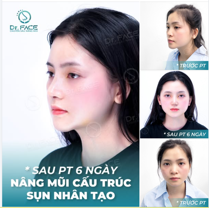 Mũi xinh mới sửa chưa lâu,  Mà ai cũng hỏi: “Gái Hàn hay sao?”