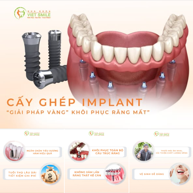 CẤY GHÉP IMPLANT – “GIẢI PHÁP VÀNG” ĐỂ KHÔI PHỤC RĂNG MẤT
