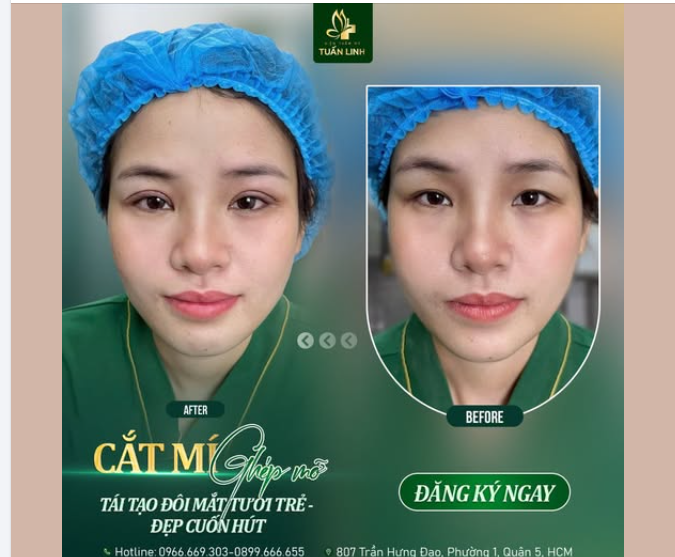 Cắt mí ghép mỡ - Tái tạo đôi mắt tươi trẻ, đẹp cuốn hút!!