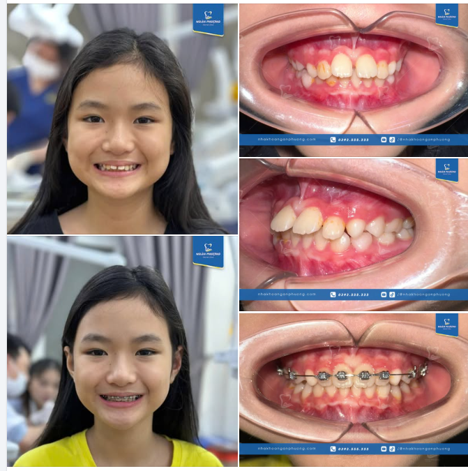 Niềng răng mái mưa tuổi dậy thì, đón diện mạo 10 phân vẹn 10