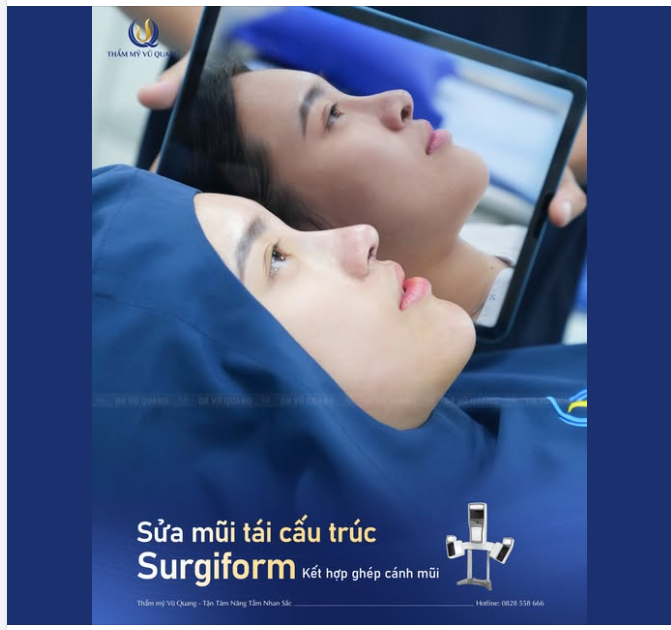 Kết quả nâng mũi Surgiform tại cho bạn gái Việt Kiều Đức