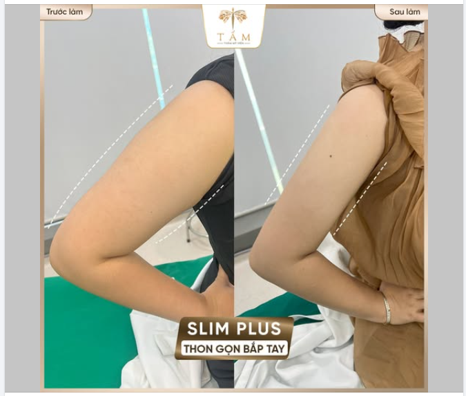 Không thừa cân nhưng vẫn có ‘vai u thịt bắp’? Đâu là bí quyết dành cho bạn?