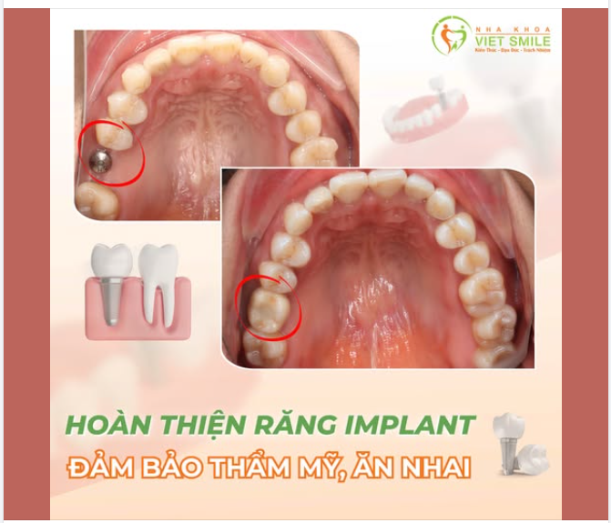 HOÀN THIỆN RĂNG SỐ 6 BẰNG IMPLANT – ĐẢM BẢO THẨM MỸ, PHỤC HỒI ĂN NHAI
