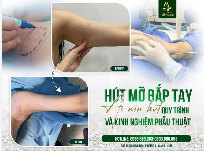 HÚT MỠ BẮP TAY - AI NÊN HÚT, QUY TRÌNH VÀ KINH NGHIỆM PHẪU THUẬT!!