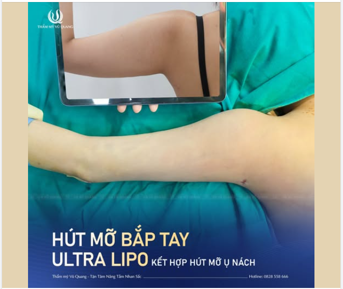 Hút mỡ bắp tay - Thon ngay sau 1 lần thực hiện