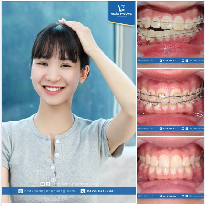 Từ răng uốn lượn đến thẳng tắp như bắp, Minh Ngọc đã niềng răng như thế nào?