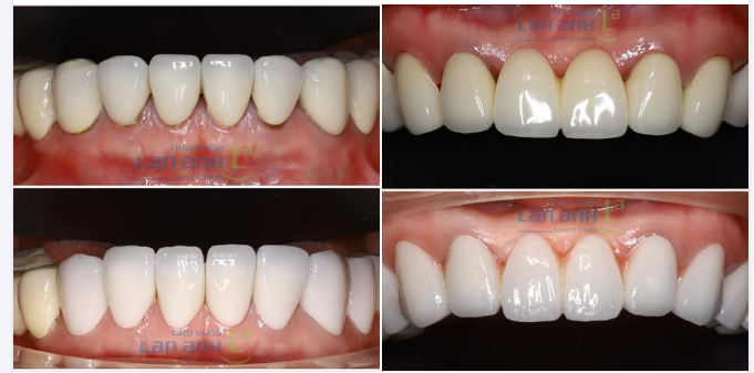 Răng sứ làm tại nơi khác, chỉ sau một thời gian sử dụng là bị hở, bị vênh,…