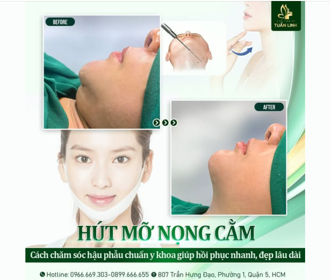 Hút mỡ nọng cằm - Cách chăm sóc hậu phẫu chuẩn y khoa!!
