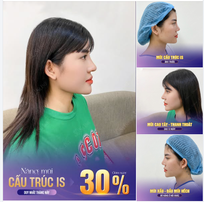 LỘT XÁC VỚI MŨI CẤU TRÚC IS.