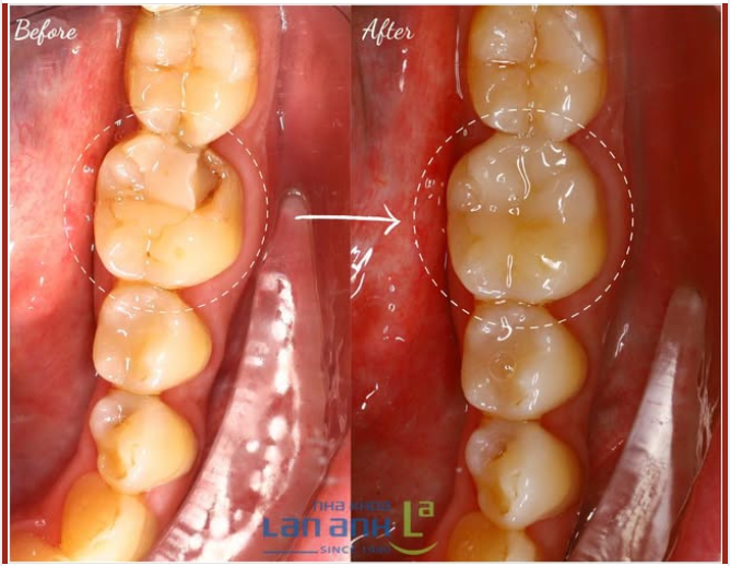 Năm 2025 rồi, đừng trám răng tạm bợ nữa, mà hãy thay bằng Inlay sứ, vừa đẹp vừa bền lắm luôn ạ
