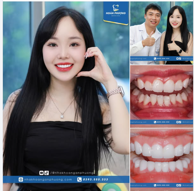 Làm xong bộ răng sứ, cảm xúc của chị Mai Anh chỉ có trên cả hài lòng vì niềm tin được nhận lại xứng đáng.