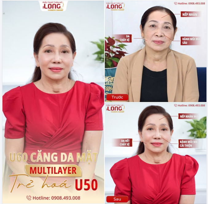 Ở độ tuổi U60, cô Thu Sương  Khách hàng đến từ Cần Thơ vẫn duy trì được sự trẻ trung xinh đẹp